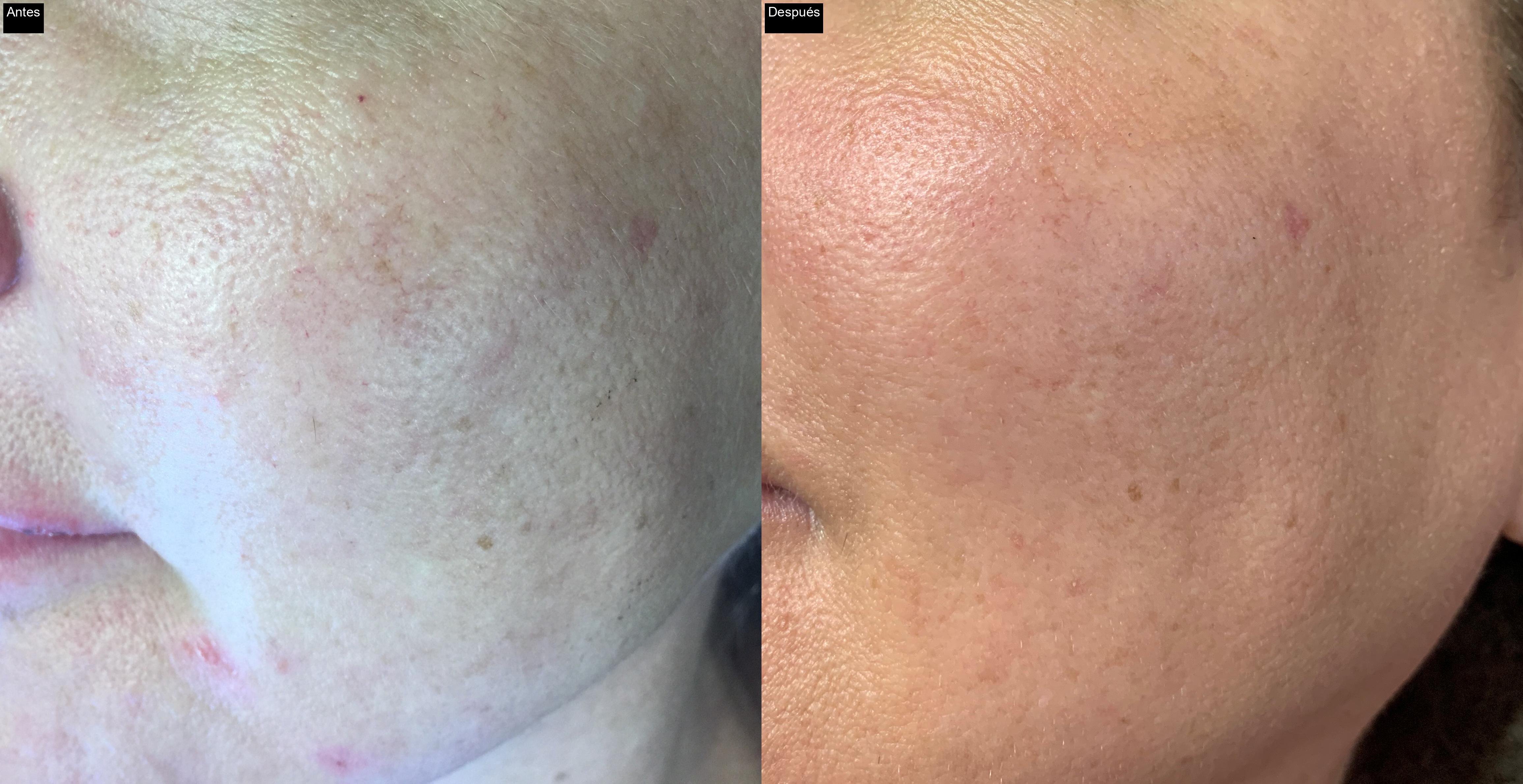 Antes / Después : Eliminación de cicatrices de acné con IPL en Jávea -2