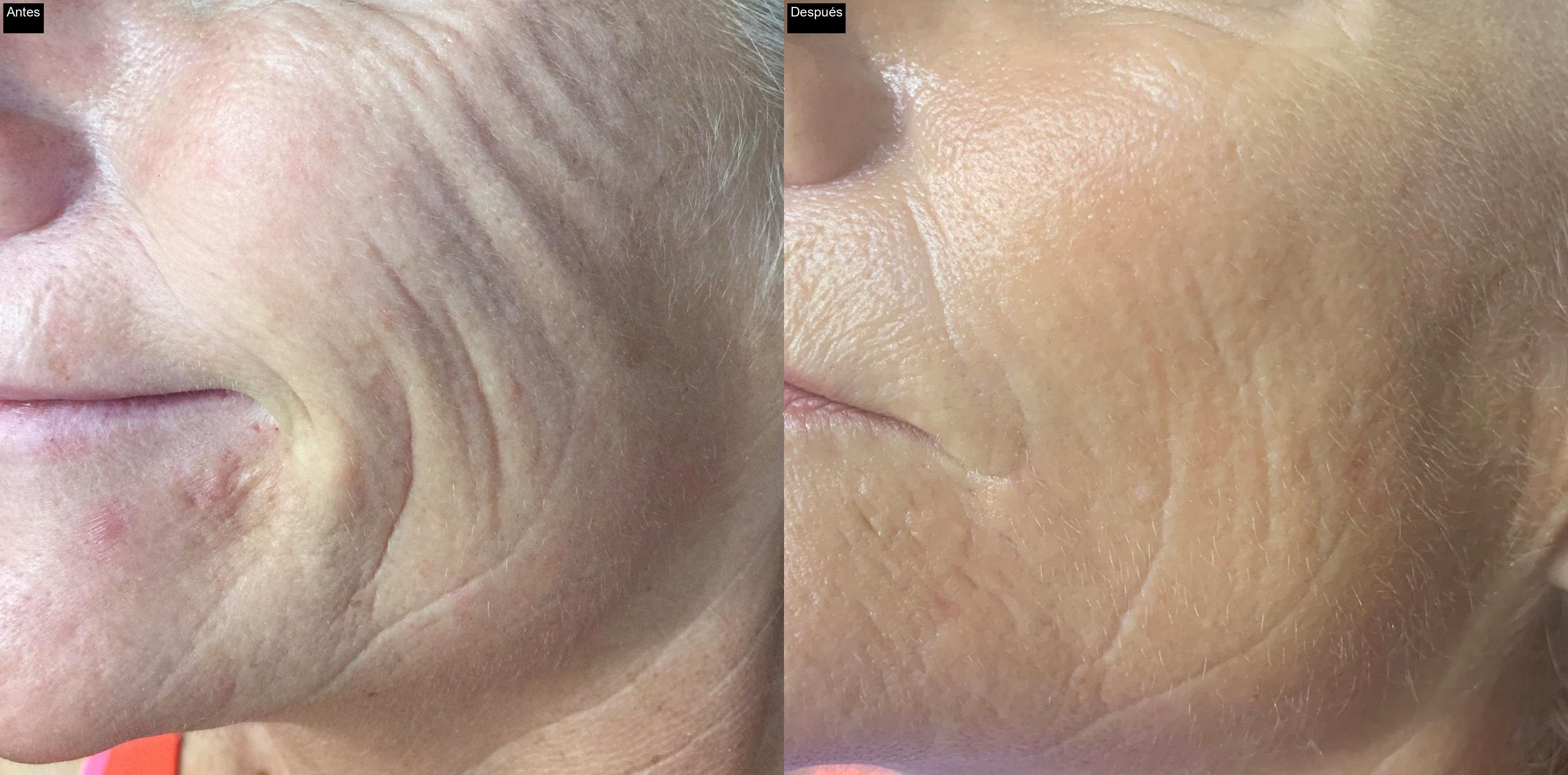 Antes / Después : Eliminación de cicatrices de acné con IPL en Jávea -3