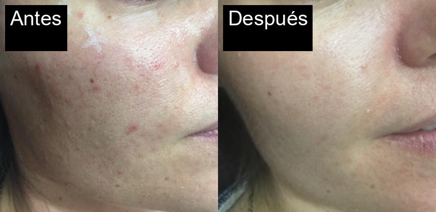 Antes / Después : Eliminación de cicatrices de acné con IPL en Jávea -4