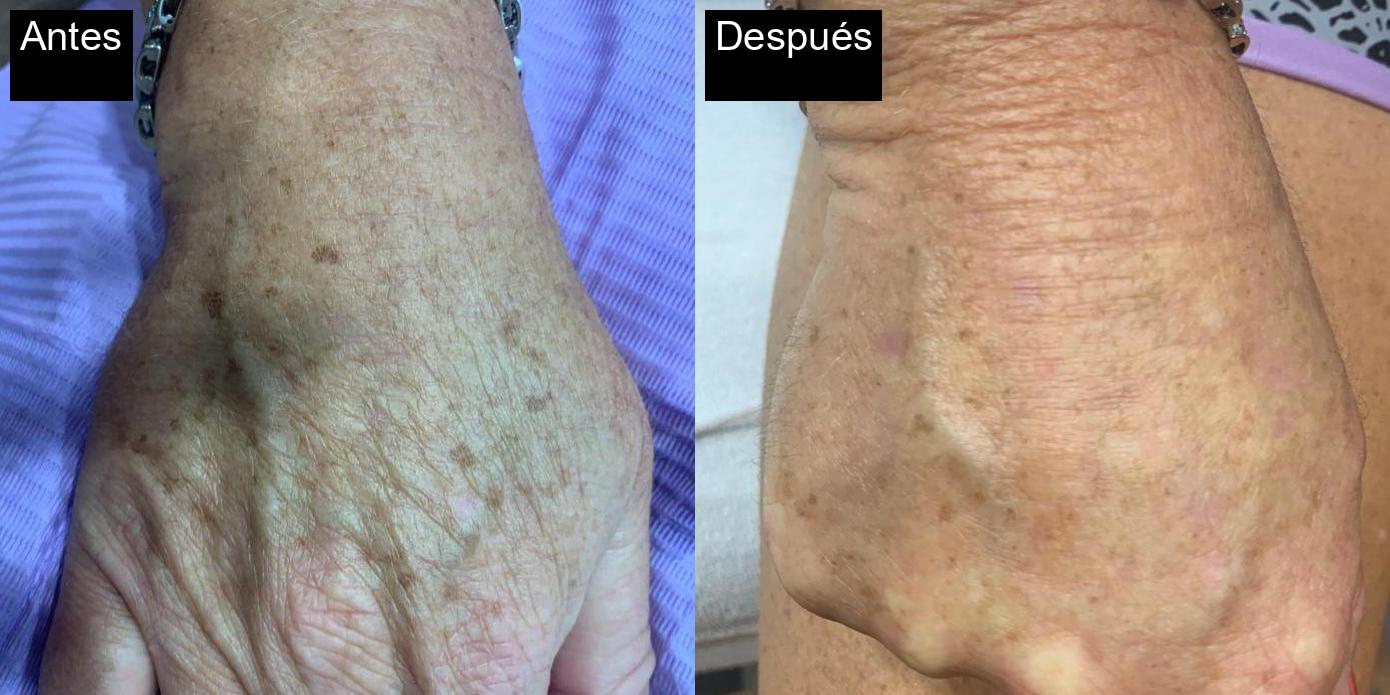 Antes / Después : Tratamiento de fotorejuvenecimiento en Jávea -1