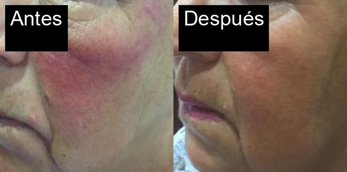 Antes / Después : Tratamiento de fotorejuvenecimiento en Jávea -2