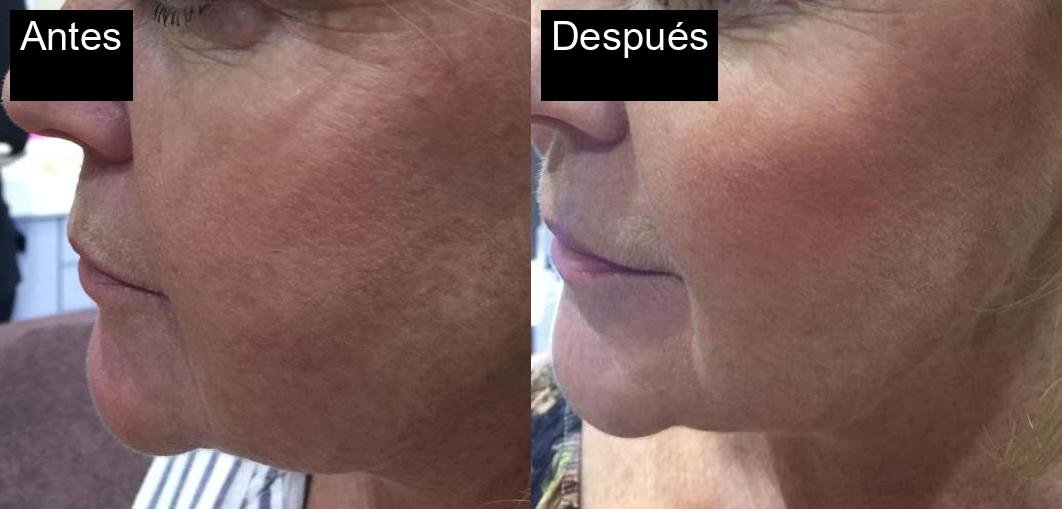 Antes / Después : Tratamiento de fotorejuvenecimiento en Jávea -3